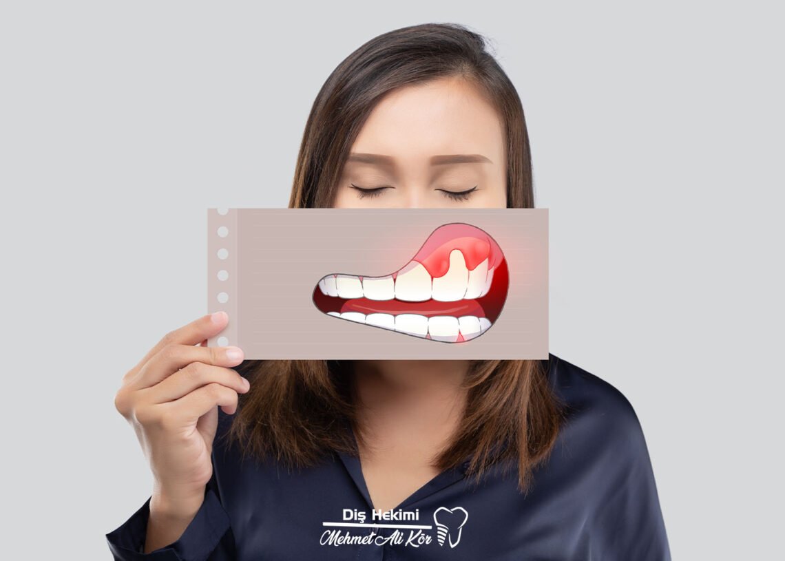 Diş Eti Hastalıkları 