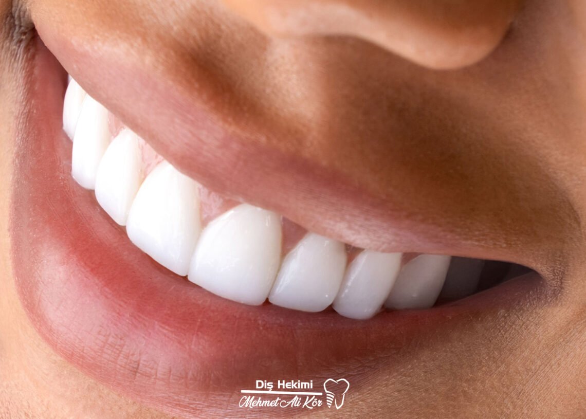 Estetik Diş Kaplamalar 
