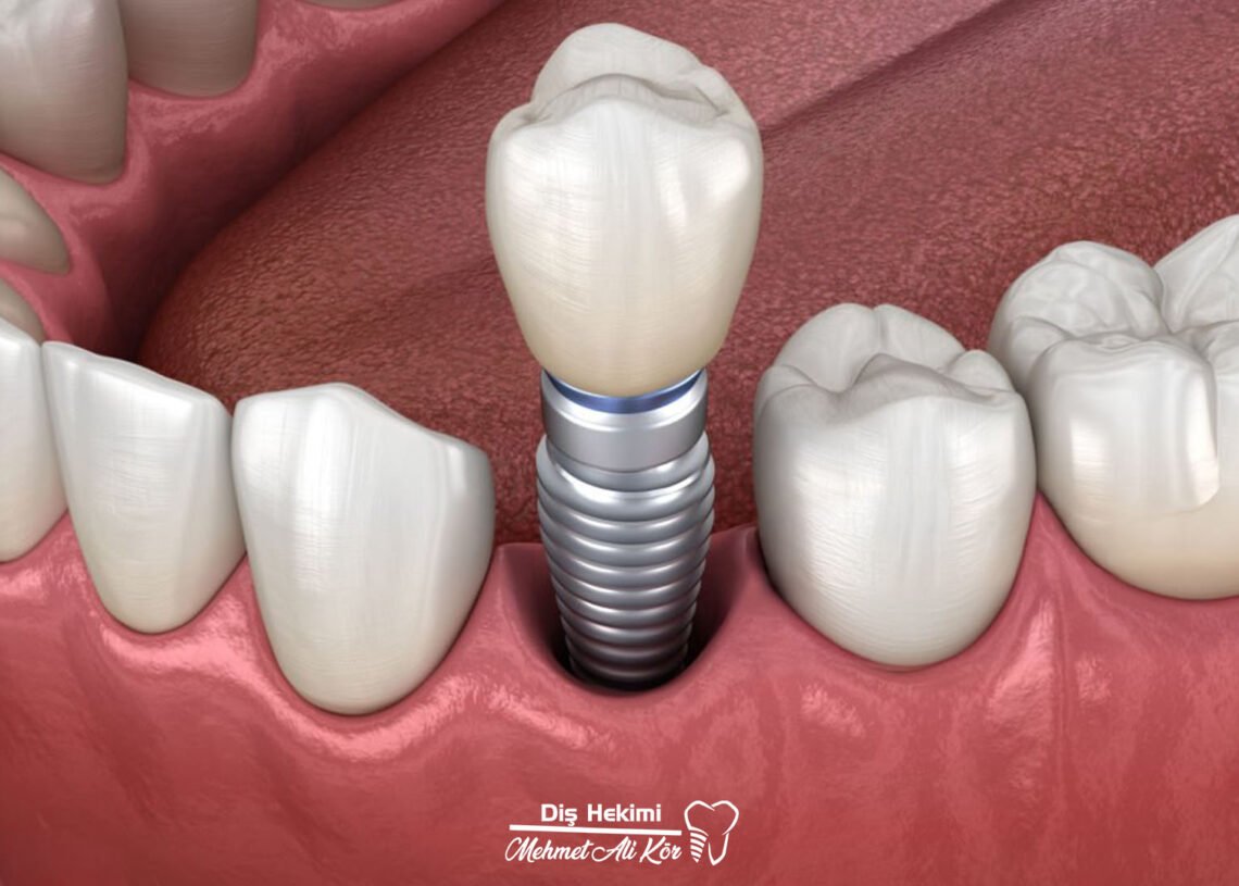 İmplant Tedavisi 